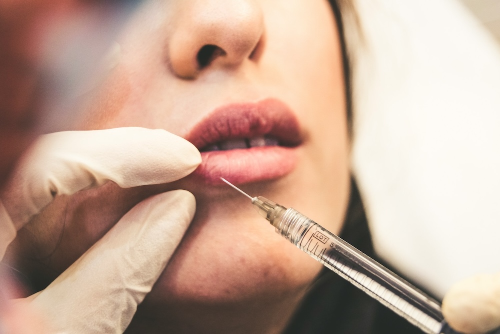 Dermal filler injection for lip enhancement to reduce static wrinkles and restore facial volume.