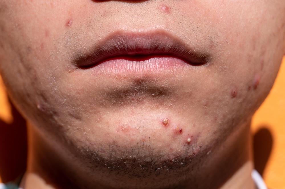 Close-up of male chin with active acne and post-acne scars under direct sunlight