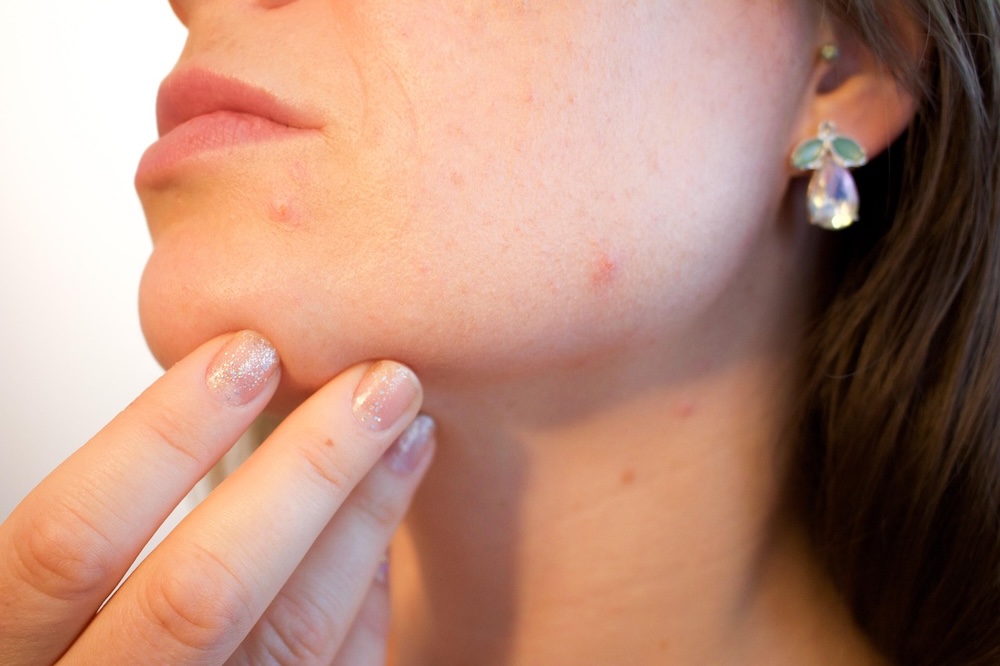 Woman examining acne on chin, considering home remedies for mild breakouts