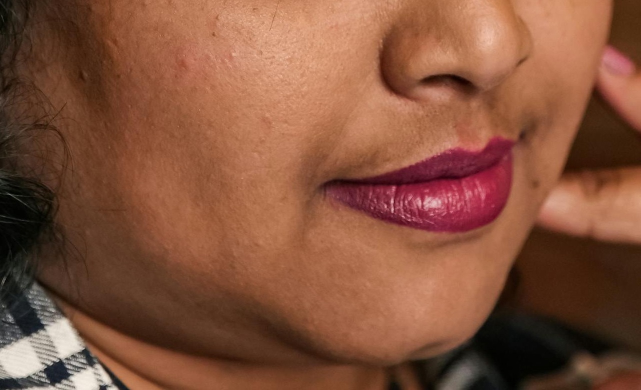 double chin treatment in malaysia