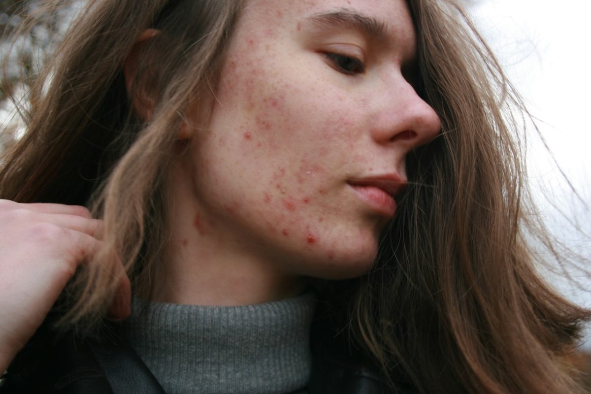 Close-up of a young woman with active acne and early acne scarring on her cheek and jawline