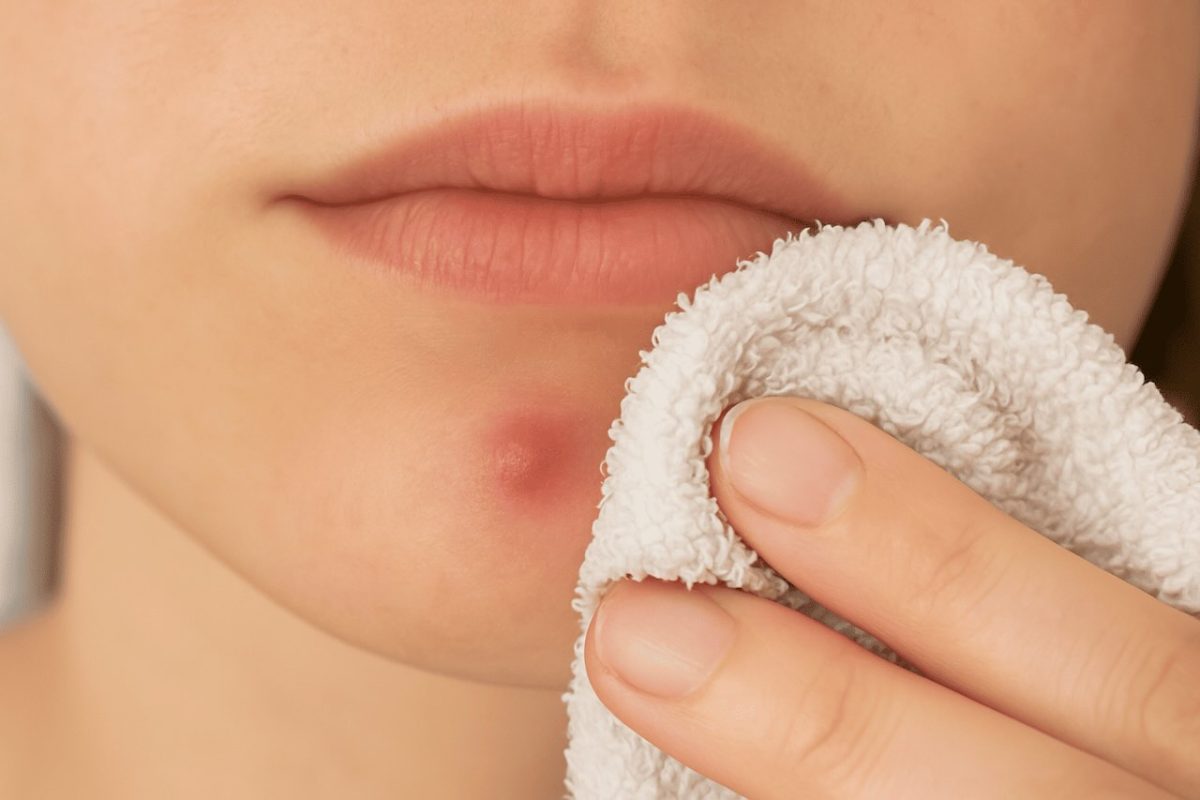 Close-up of a person gently pressing on a swollen blind pimple on the chin, highlighting redness and skin texture.