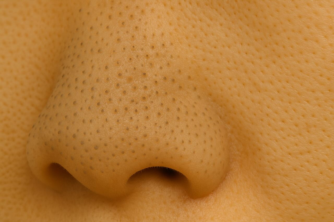 Close-up image of sebaceous filaments around the nose and cheek area
