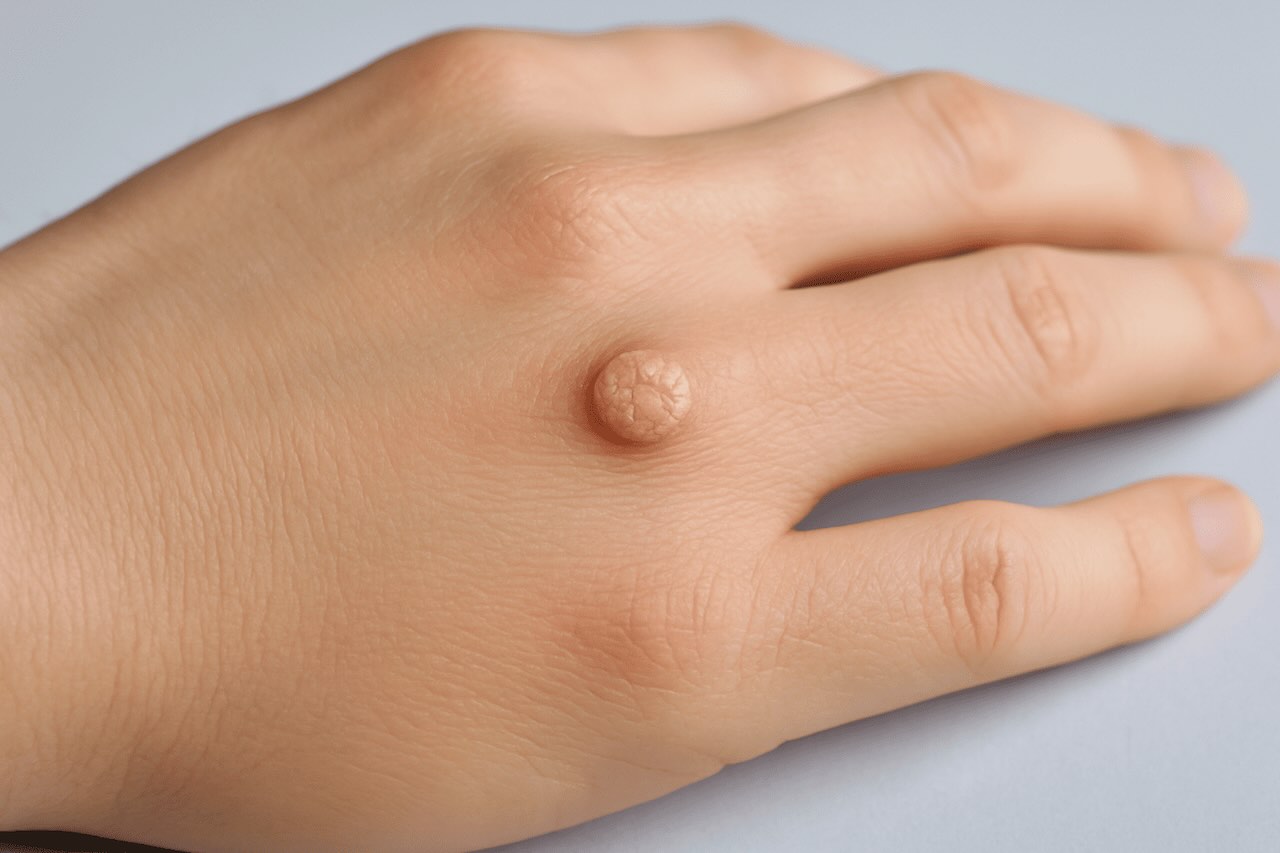 Close-up of a raised wart on the back of a human hand.