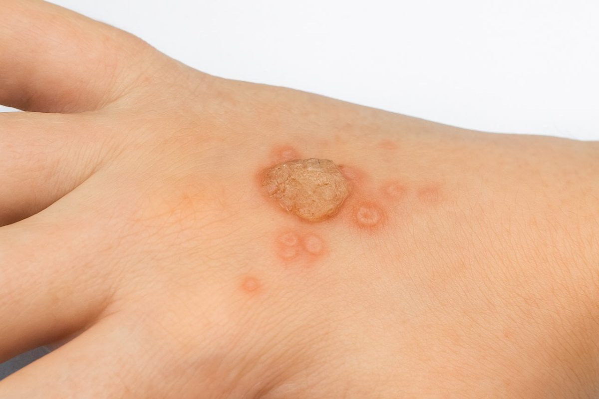 Raised wart-like bump on the back of a hand with surrounding red circular marks, showing a skin infection.