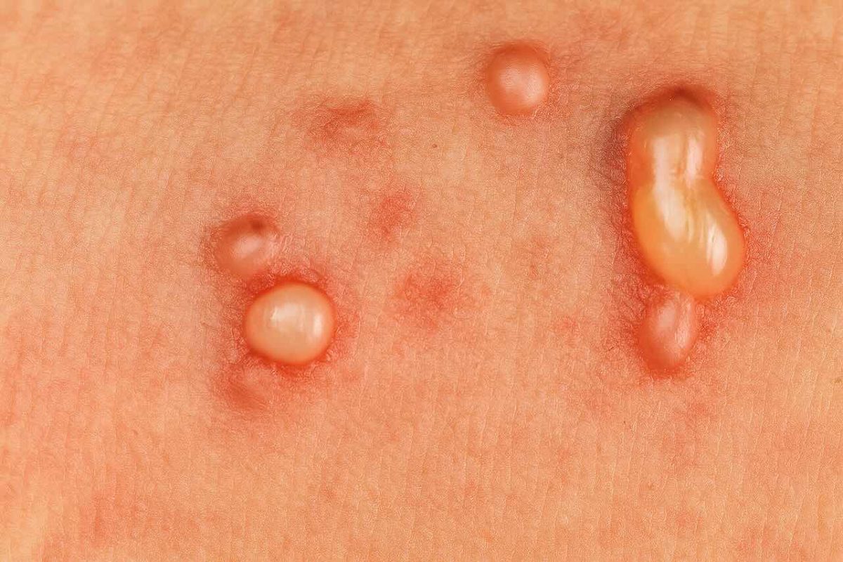 Cluster of small fluid-filled blisters on irritated skin, resembling a viral skin infection or rash.