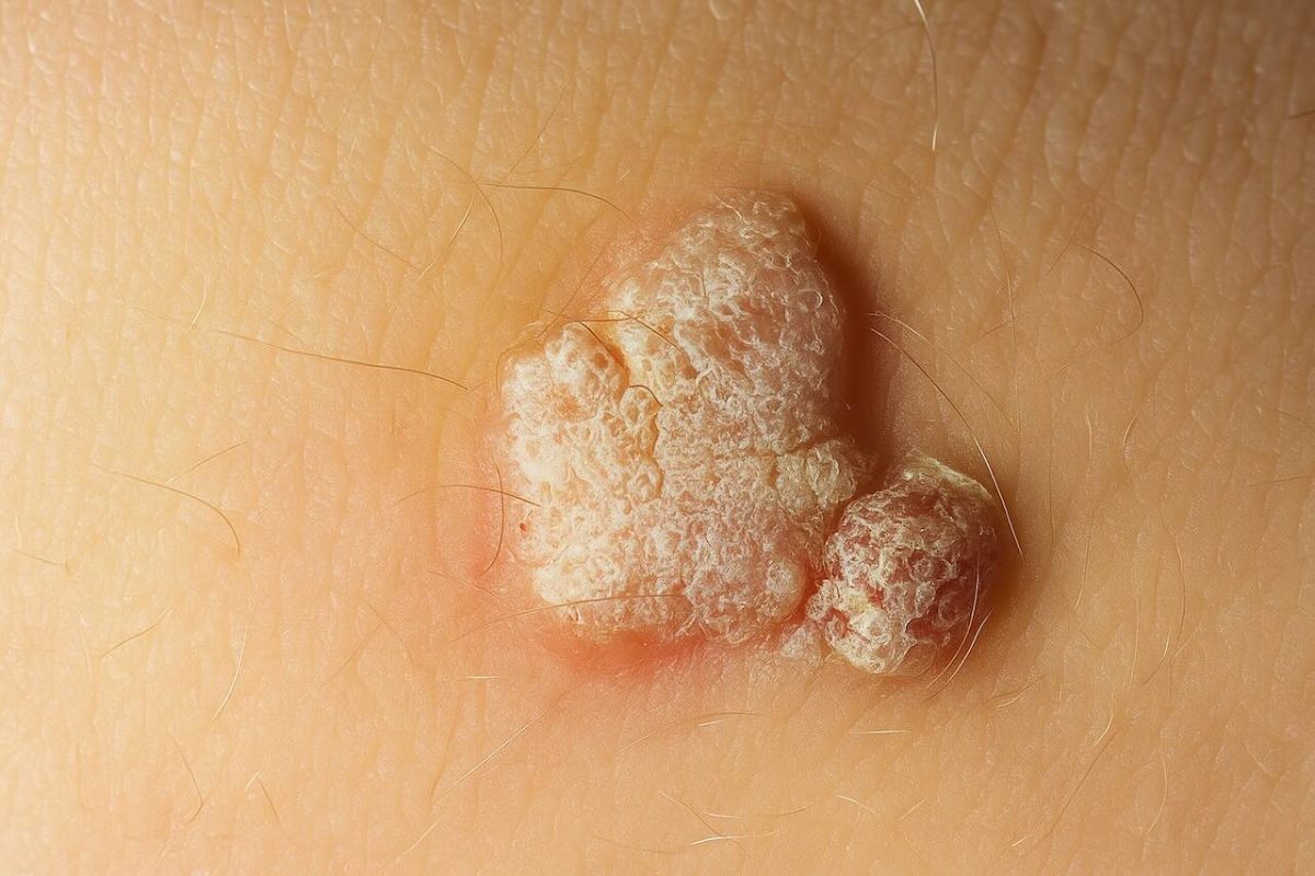 Raised wart-like bump on the back of a hand with surrounding red circular marks, showing a skin infection.