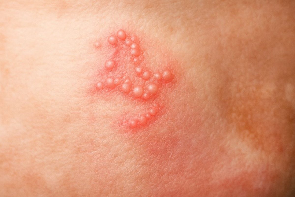 Close-up of a cluster of small, fluid-filled blisters, characteristic of a herpes simplex virus (HSV) outbreak.