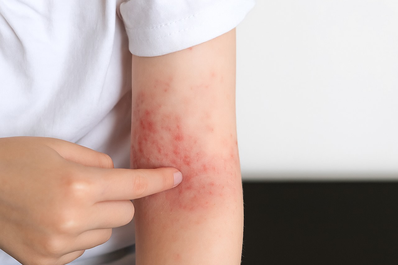 Inflamed red patches on the inner arm, possibly indicating a rash caused by a sexually transmitted infection.