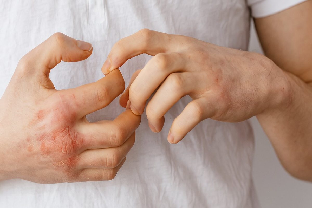 Red, irritated rash on hands, showing potential symptoms of a skin-related STI infection.