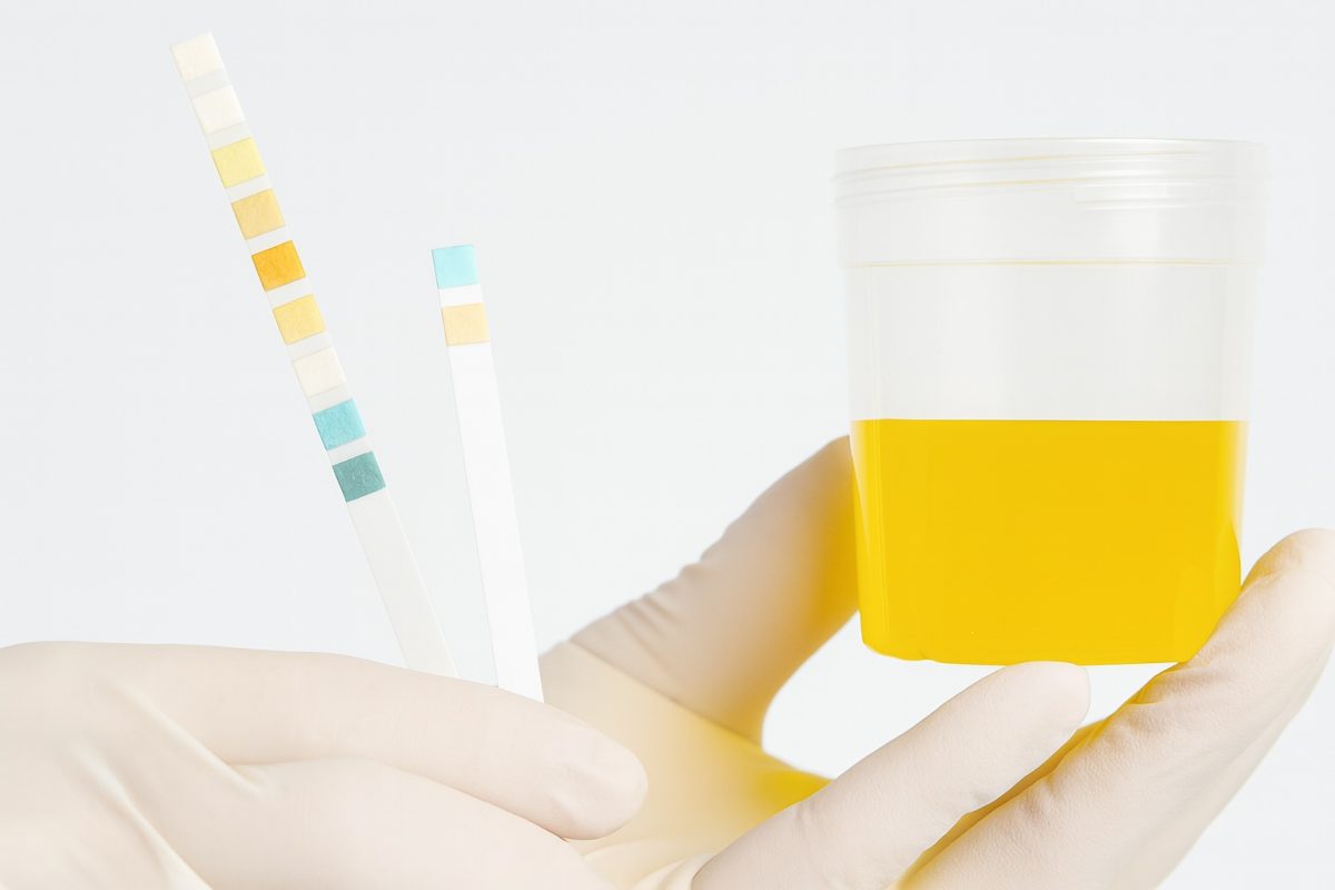 Gloved hands holding urine test strips and a sample cup used for chlamydia screening through routine urine testing.