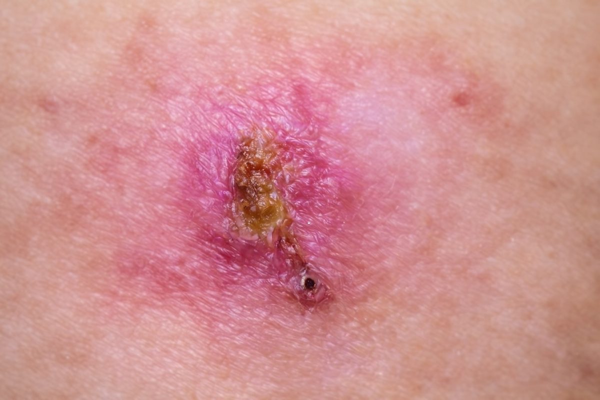 Close-up of a painful genital ulcer with redness, crusting, and inflamed surrounding skin.