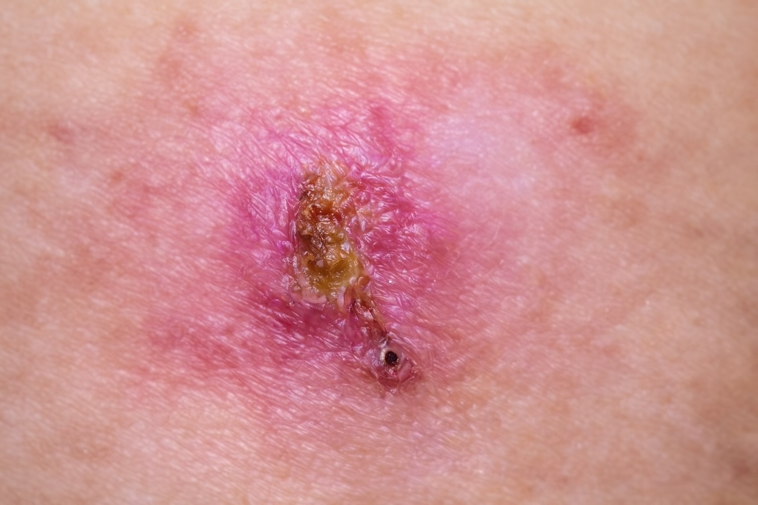 Close-up of a painful genital ulcer with redness, crusting, and inflamed surrounding skin.