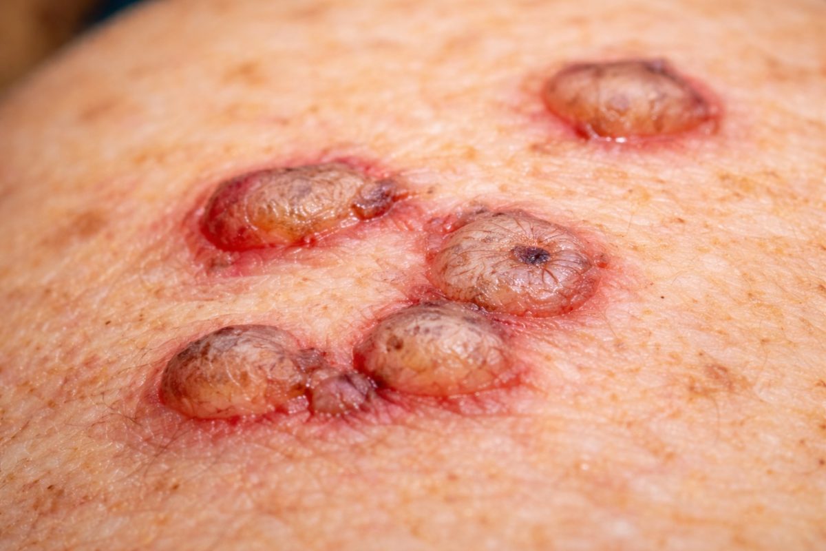 Close-up of painful raised genital ulcers with redness and swelling, illustrating skin symptoms linked to chancroid.