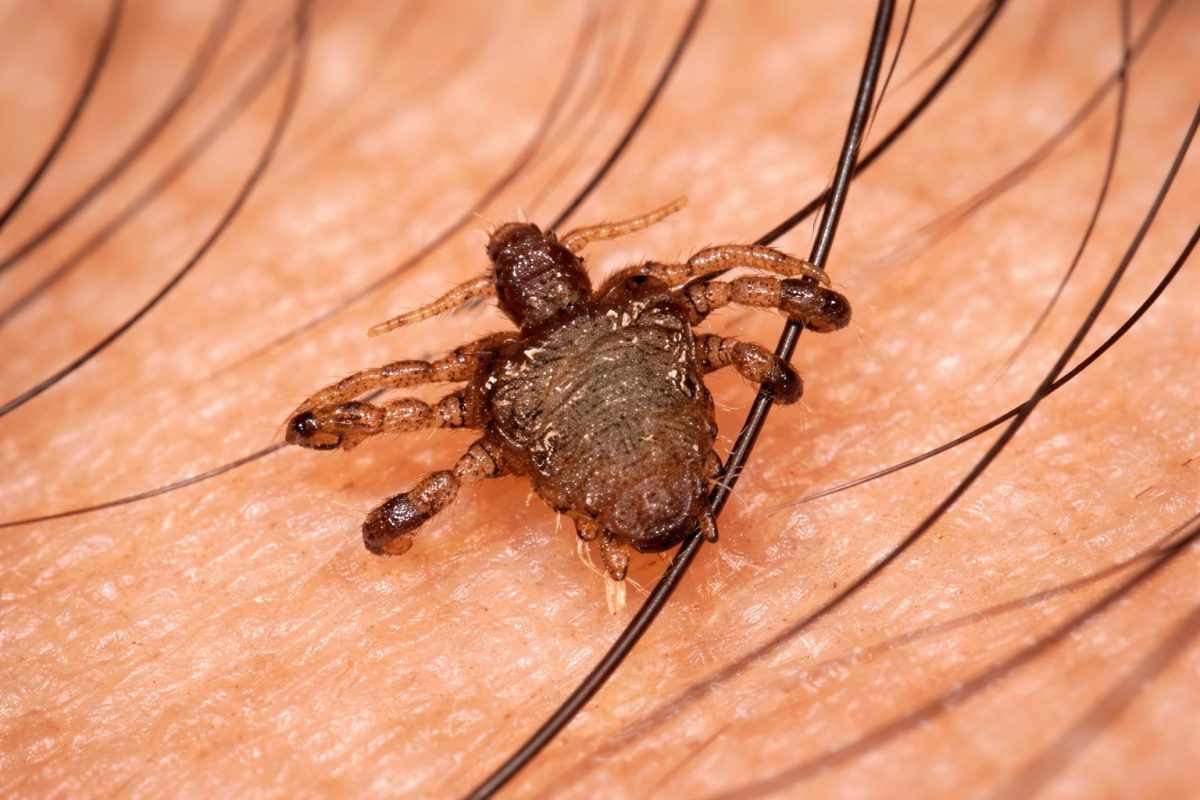 Magnified view of a pubic louse gripping hair strands, revealing the parasite’s body, legs, and claws.
