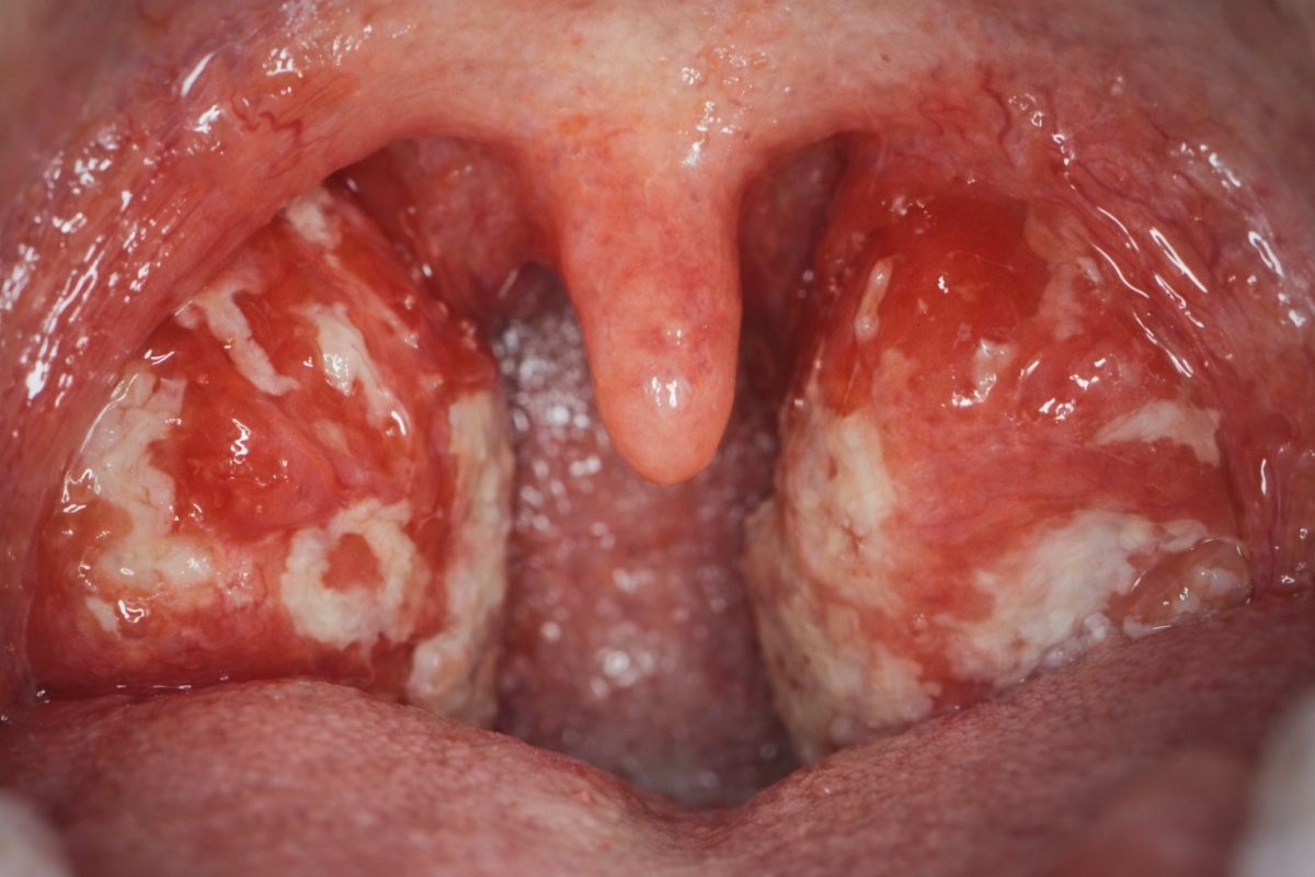 Swollen tonsils with white patches, a common sign of infectious mononucleosis caused by Epstein-Barr virus.