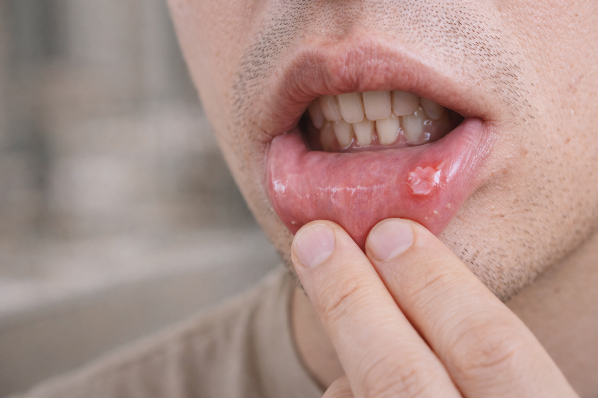 Close-up of throat lesions caused by oral STD infection after unprotected oral sex