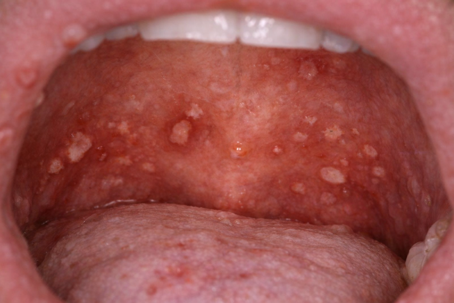Painful mouth ulcer linked to possible herpes or syphilis infection from oral contact