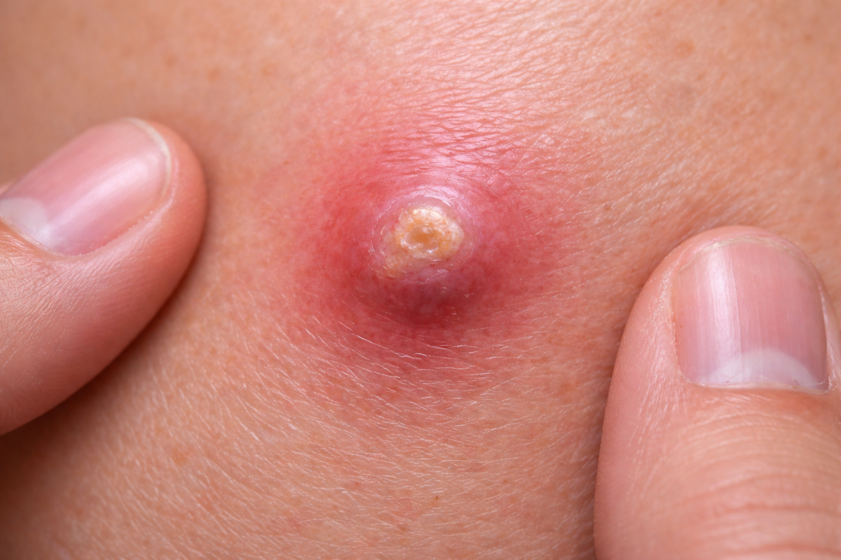 Close-up of an inflamed genital boil with pus-filled center and surrounding redness, shown between two fingers.
