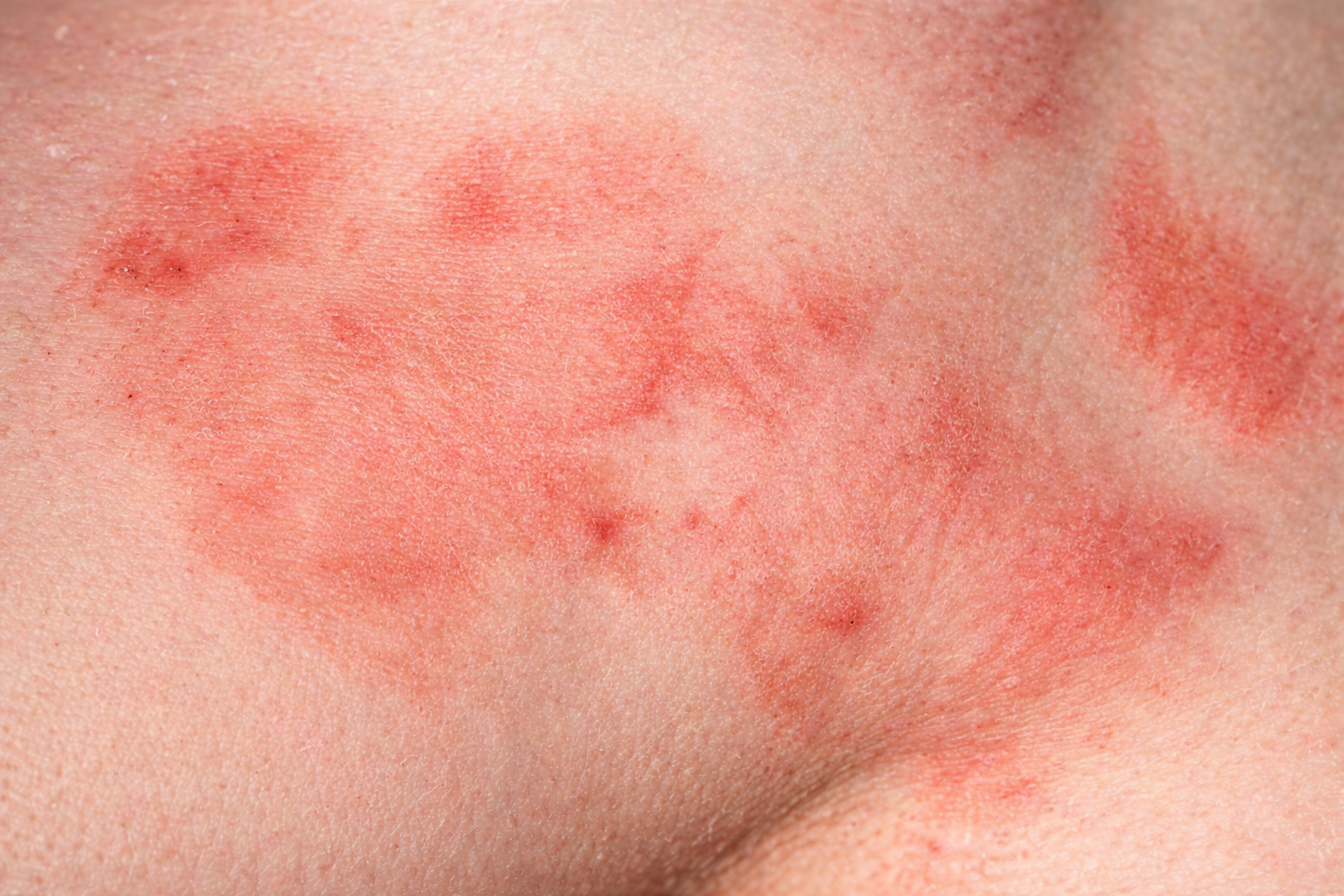 Close-up of irritated skin with red, patchy rash and inflammation commonly seen in genital fungal infections.