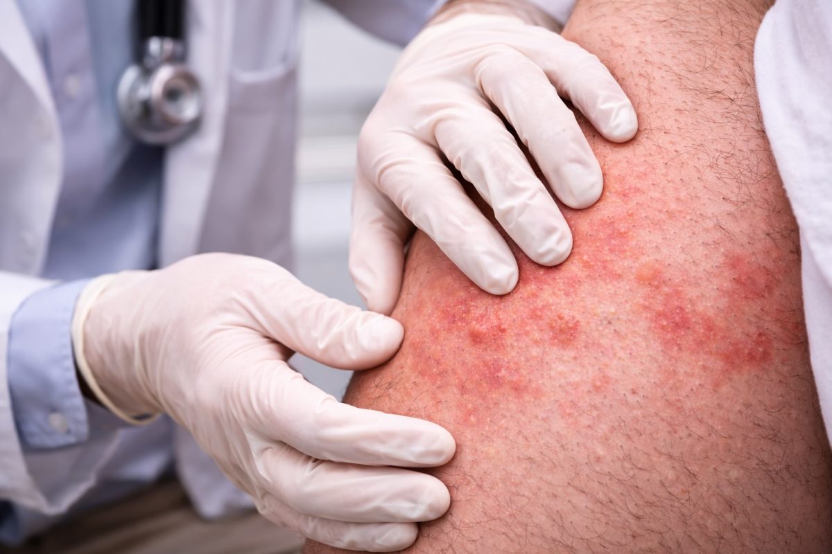 Seorang doktor memeriksa ruam pada badan pesakit