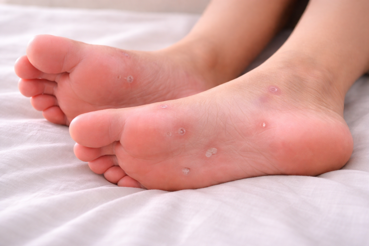 Skin rash and small lesions on the soles of feet, a common secondary sign of syphilis affecting palms and soles.
