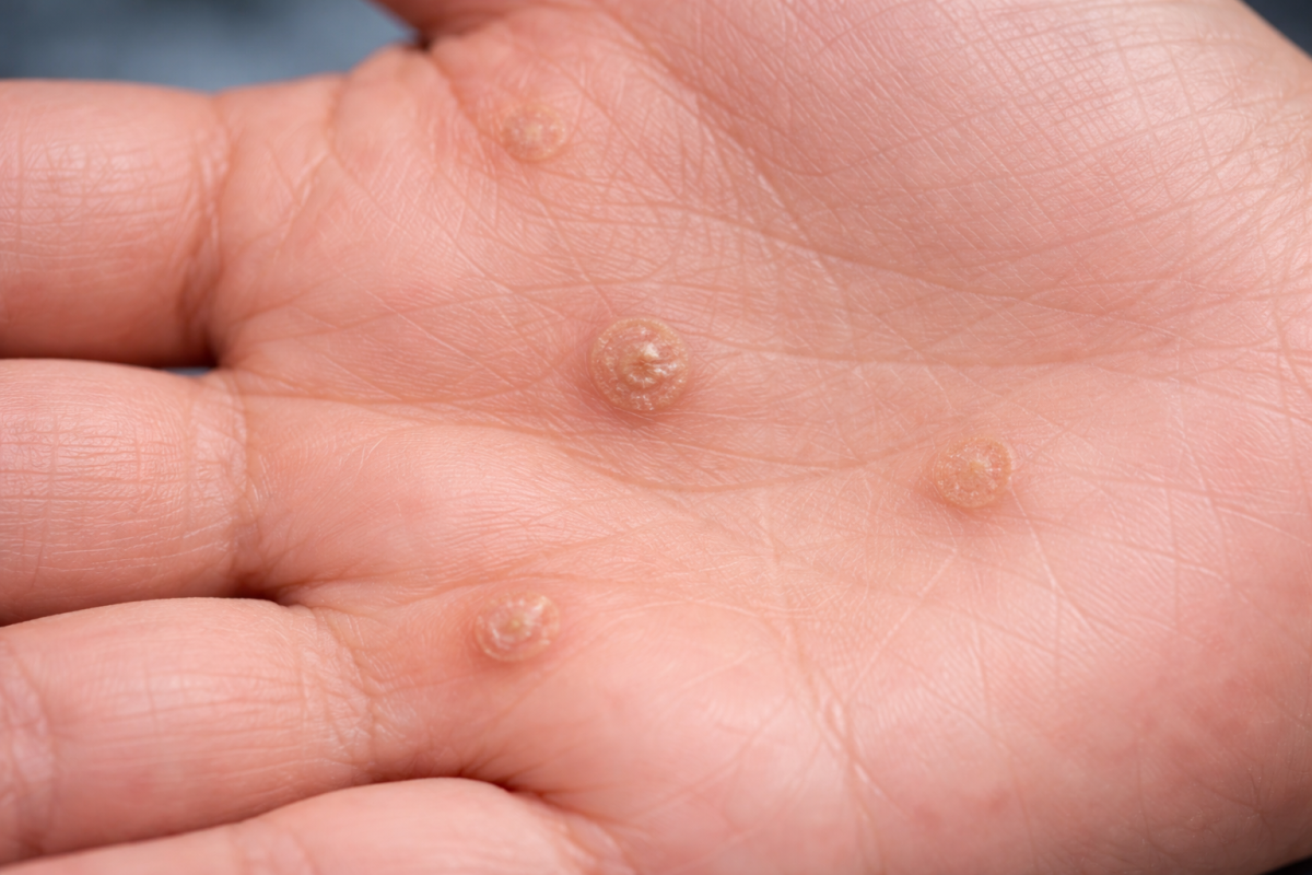 Close-up of painful blister clusters on the hand that may resemble herpes or severe, untreated STD infection signs.