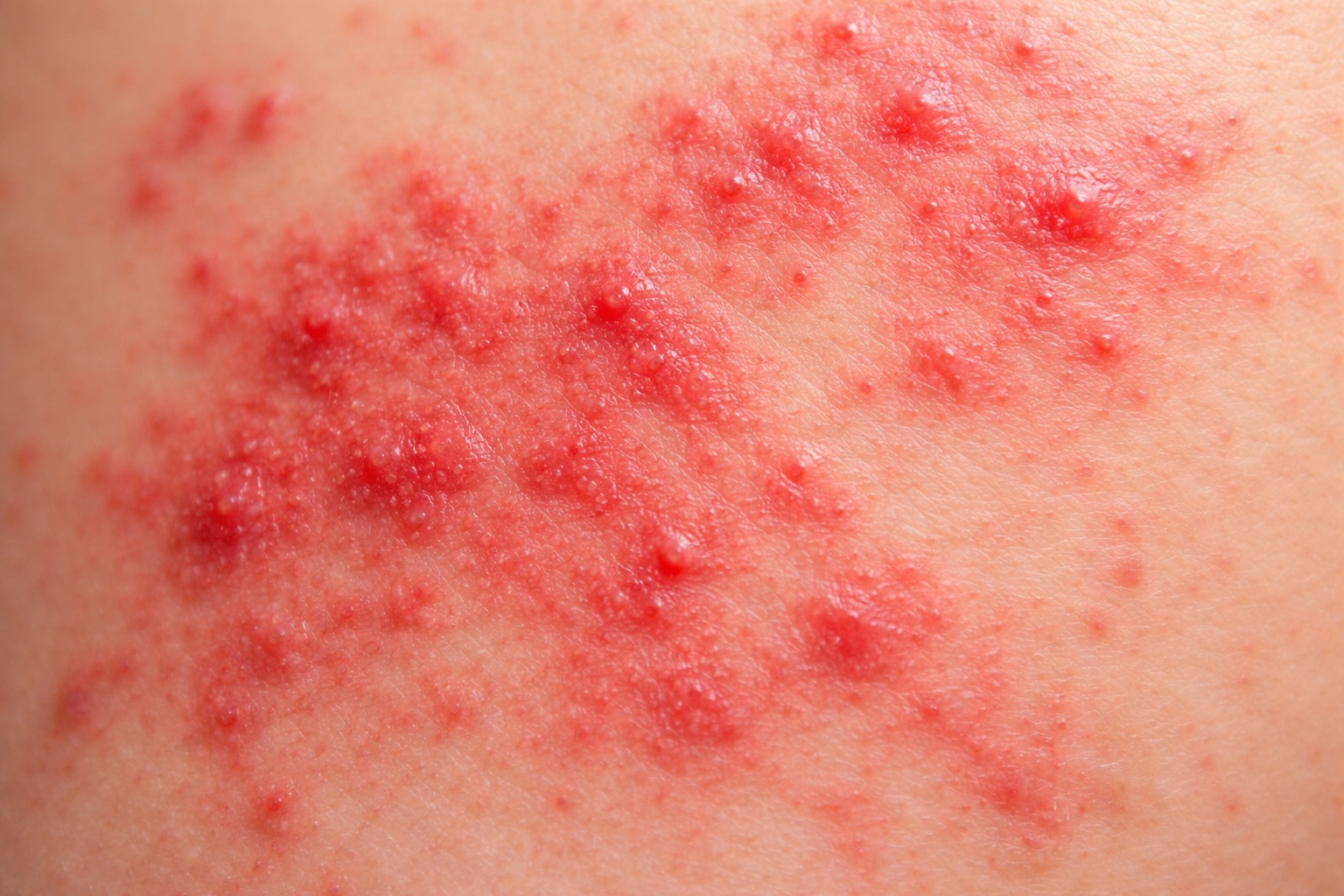 image of a rash on the skin