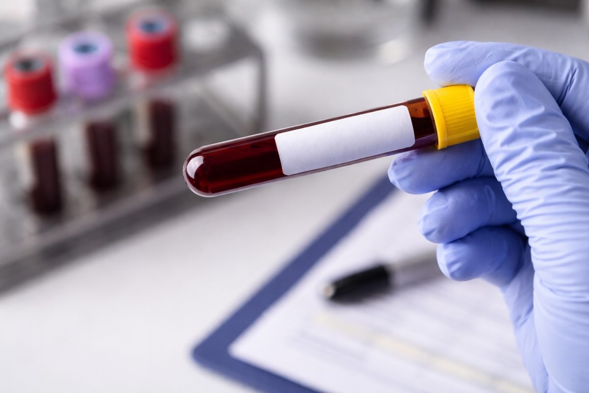 Blood sample test tube in a medical setting, representing STD testing, diagnosis, and laboratory screening