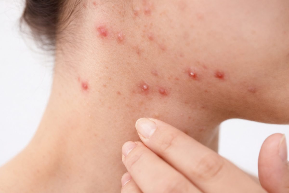 Folliculitis on the neck with red, inflamed bumps around hair follicles caused by shaving and bacterial infection