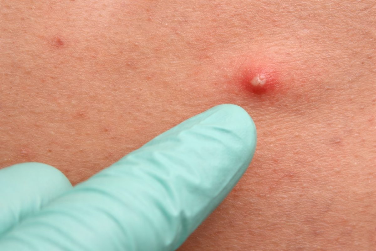 Close-up of inflamed folliculitis with pus-filled bump showing infected hair follicle and skin irritation