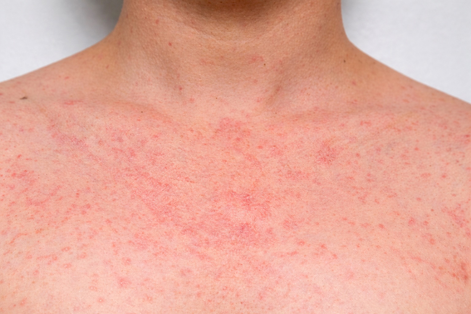 Close-up of heat rash on chest showing red bumps and skin irritation caused by sweat and blocked pores in hot weather