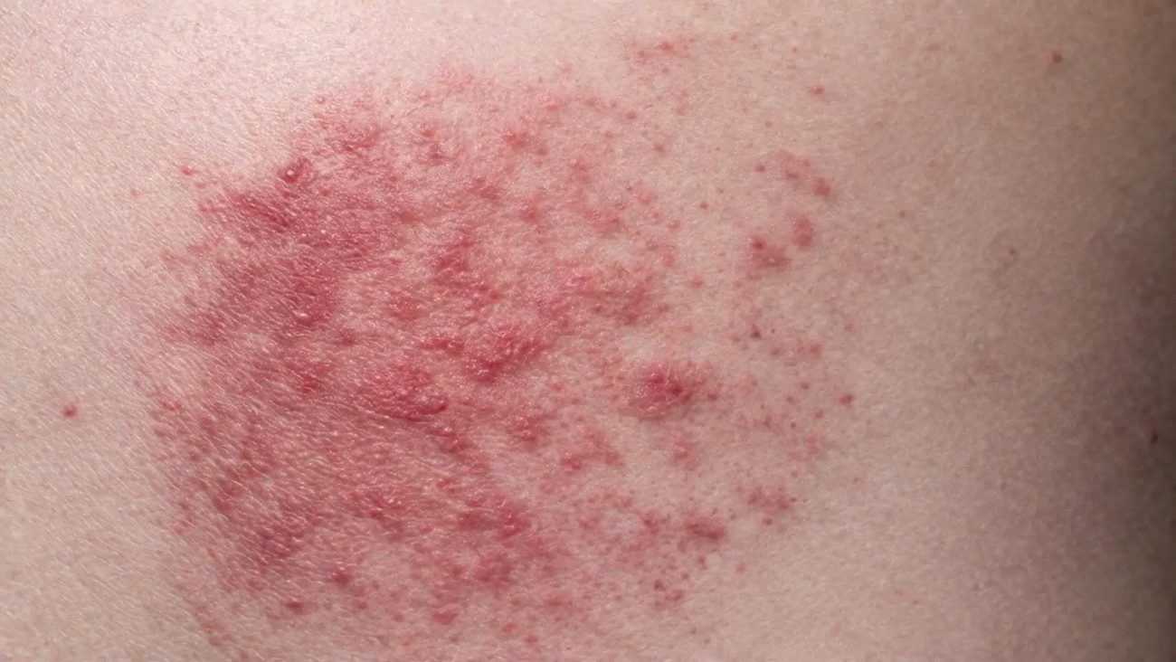 Detailed view of miliaria heat rash with inflamed red patches and small bumps on skin due to excessive sweating