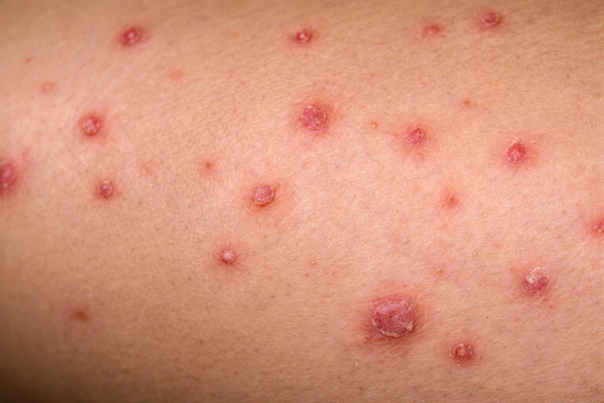 close-up of skin lesions and bumps, illustrating possible STD-related symptoms or infection requiring medical evaluation