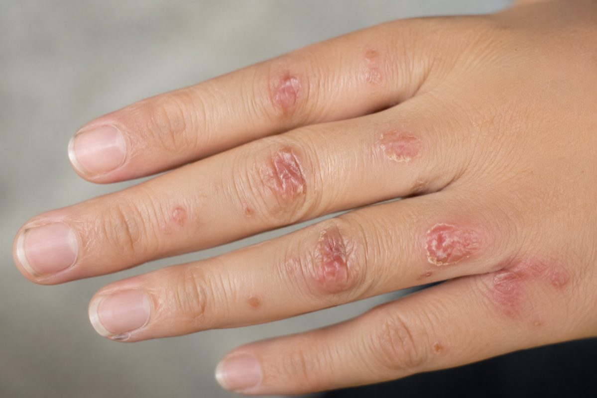 Close-up of hand rashes and skin lesions linked to chronic viral infection or sexually transmitted disease symptoms.