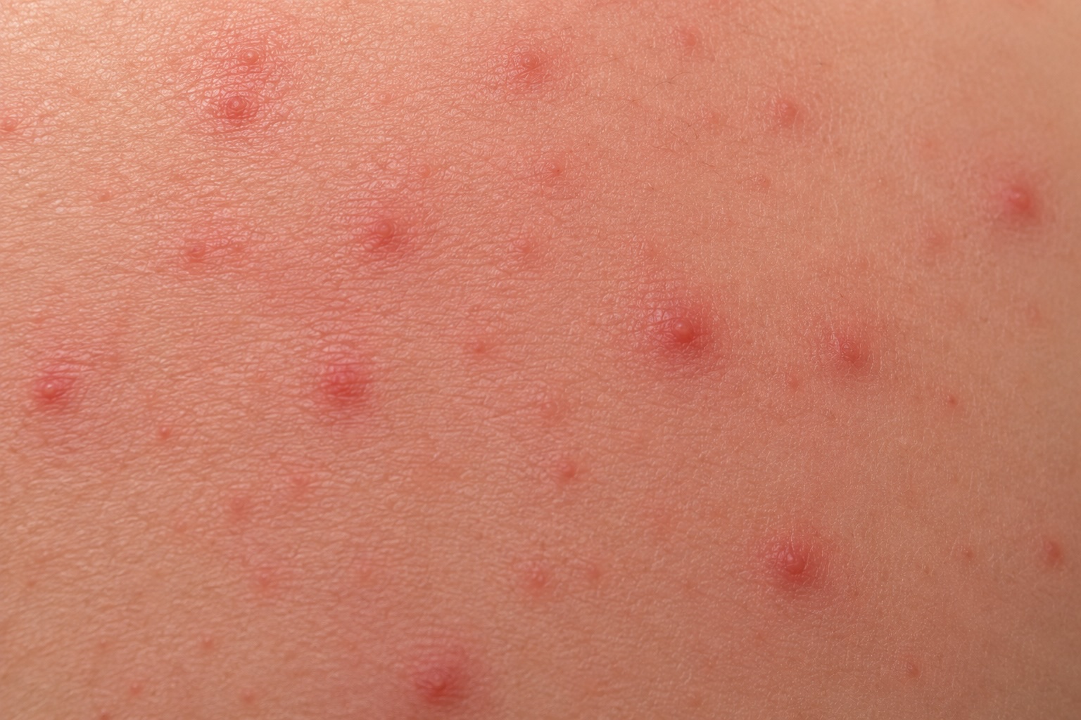 Close-up of red, inflamed skin bumps resembling rash, irritation, or viral skin infection symptoms